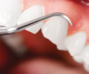 Oral Probiotics Combat Gum Disease