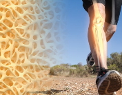 Osteoporose. Die Bedeutung der Knochengesundheit