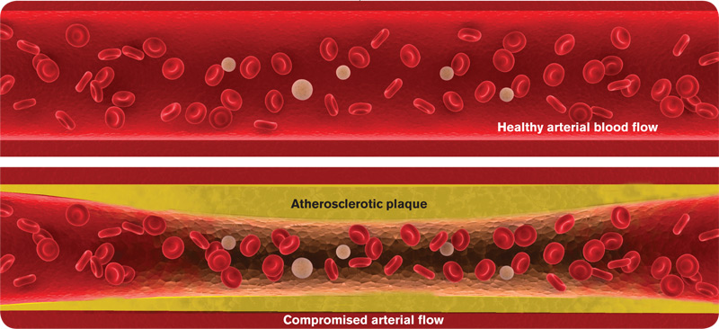 Quercetin senkt Cholesterin, bekämpft Atherosklerose