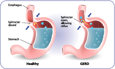 Block The Deadly Effects Of Acid Reflux_01