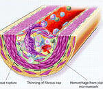 atherosclerose